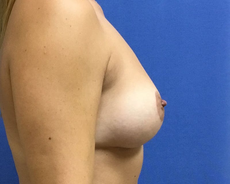Breast Lift (Mastopexy) Before & After Gallery - Patient 90416133 - Image 6