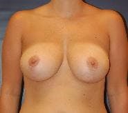 Breast Lift (Mastopexy) Gallery - Patient 90418401 - Image 2
