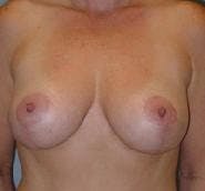 Breast Lift (Mastopexy) Gallery - Patient 90418404 - Image 2