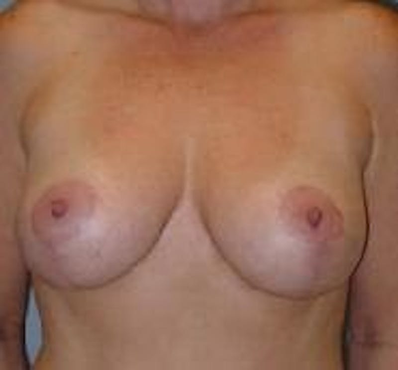 Breast Lift (Mastopexy) Before & After Gallery - Patient 90418404 - Image 2