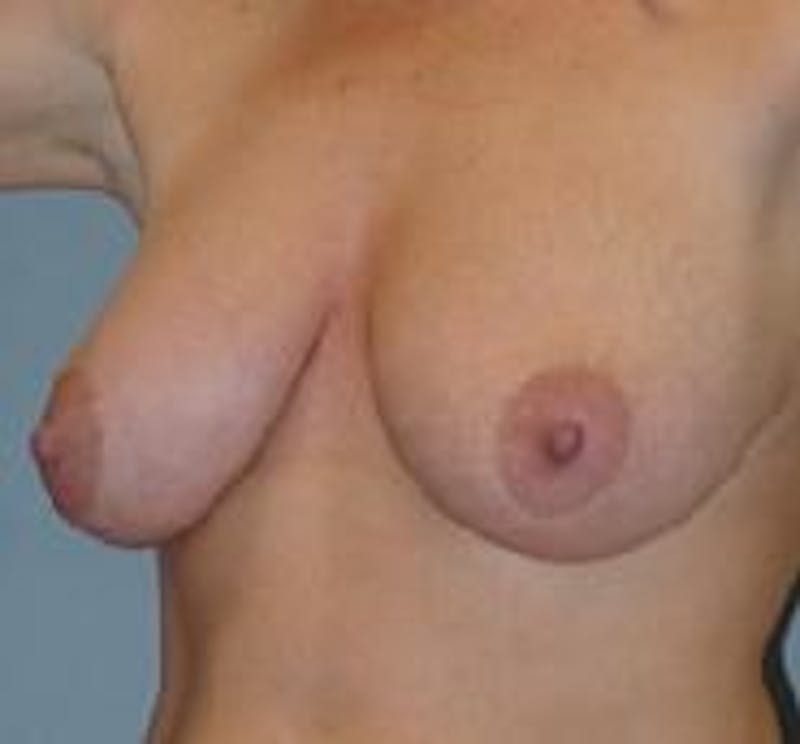 Breast Lift (Mastopexy) Before & After Gallery - Patient 90418404 - Image 3