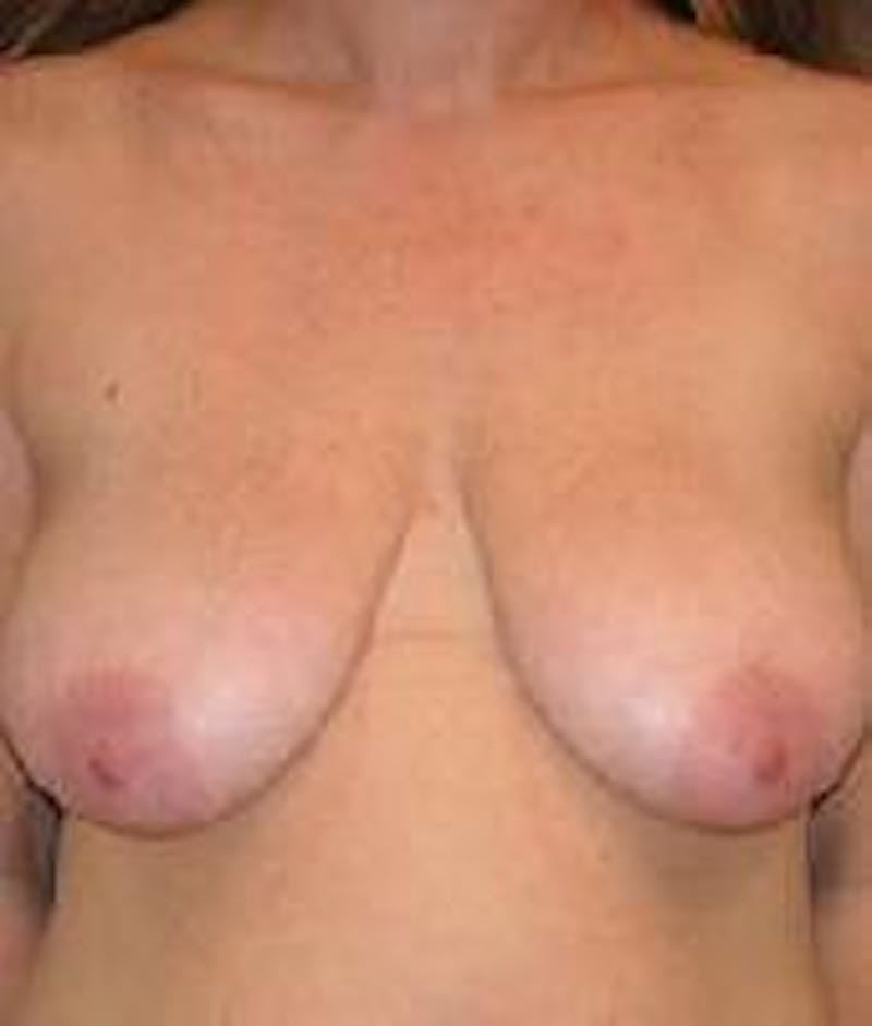 Breast Lift (Mastopexy) Before & After Gallery - Patient 90418406 - Image 1