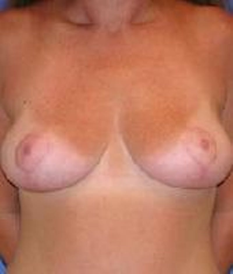 Breast Lift (Mastopexy) Before & After Gallery - Patient 90418406 - Image 2