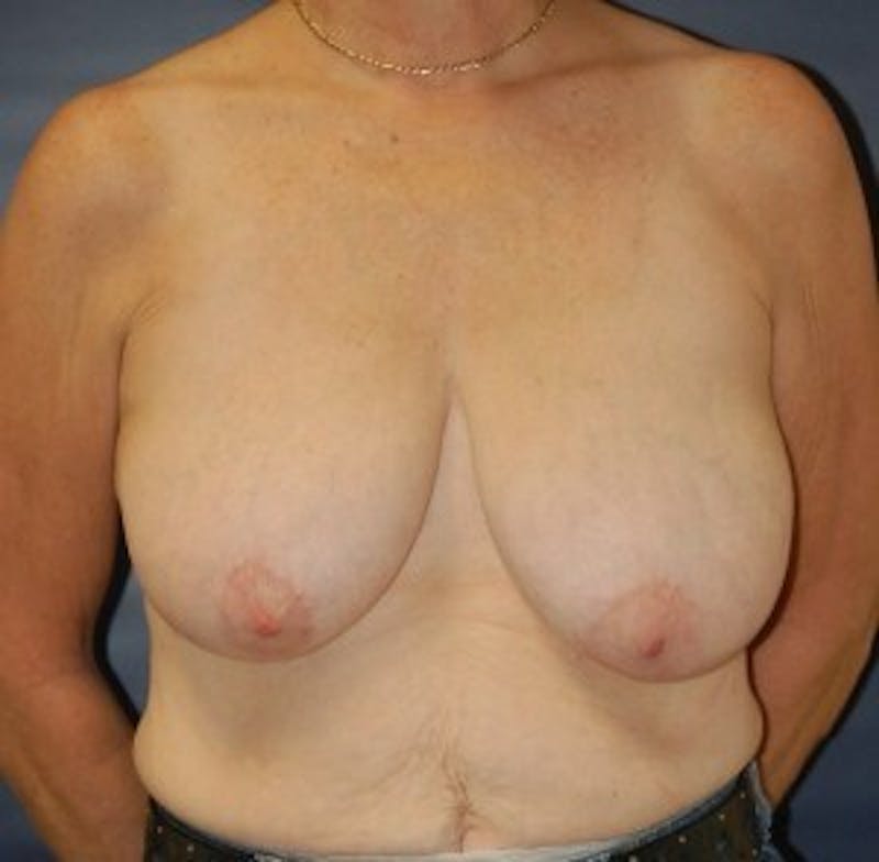 Breast Lift (Mastopexy) Before & After Gallery - Patient 90418408 - Image 1