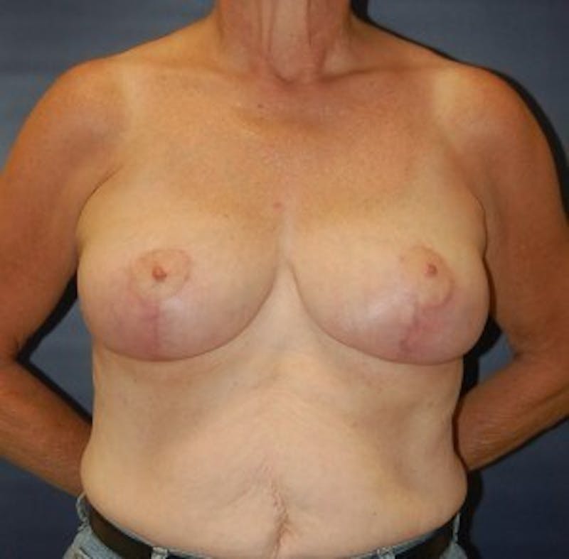 Breast Lift (Mastopexy) Before & After Gallery - Patient 90418408 - Image 2