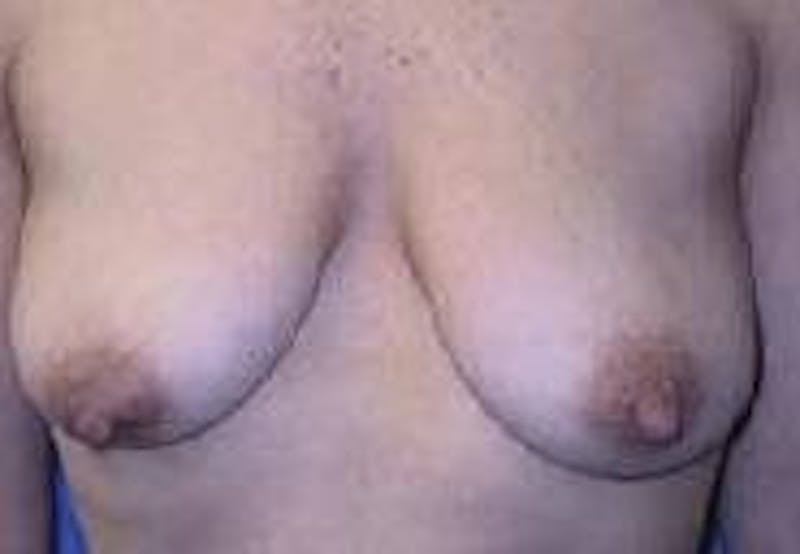 Breast Lift (Mastopexy) Before & After Gallery - Patient 90418414 - Image 1