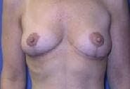 Breast Lift (Mastopexy) Gallery - Patient 90418414 - Image 2