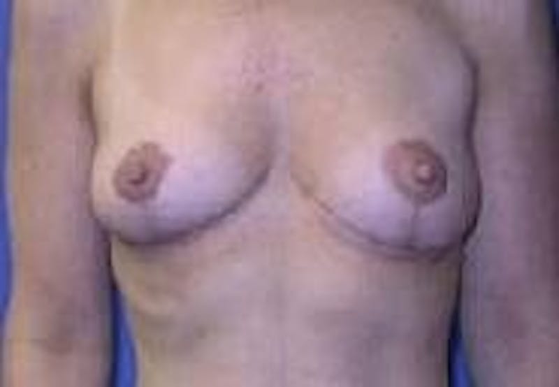 Breast Lift (Mastopexy) Before & After Gallery - Patient 90418414 - Image 2