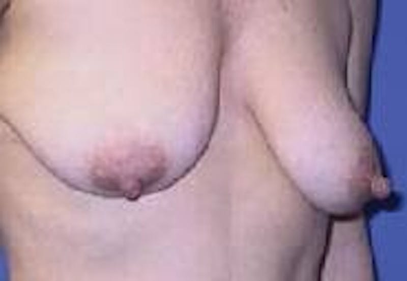 Breast Lift (Mastopexy) Before & After Gallery - Patient 90418414 - Image 3