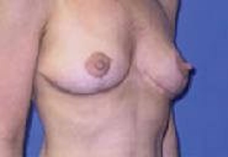 Breast Lift (Mastopexy) Before & After Gallery - Patient 90418414 - Image 4