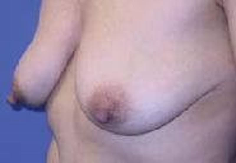 Breast Lift (Mastopexy) Before & After Gallery - Patient 90418414 - Image 5