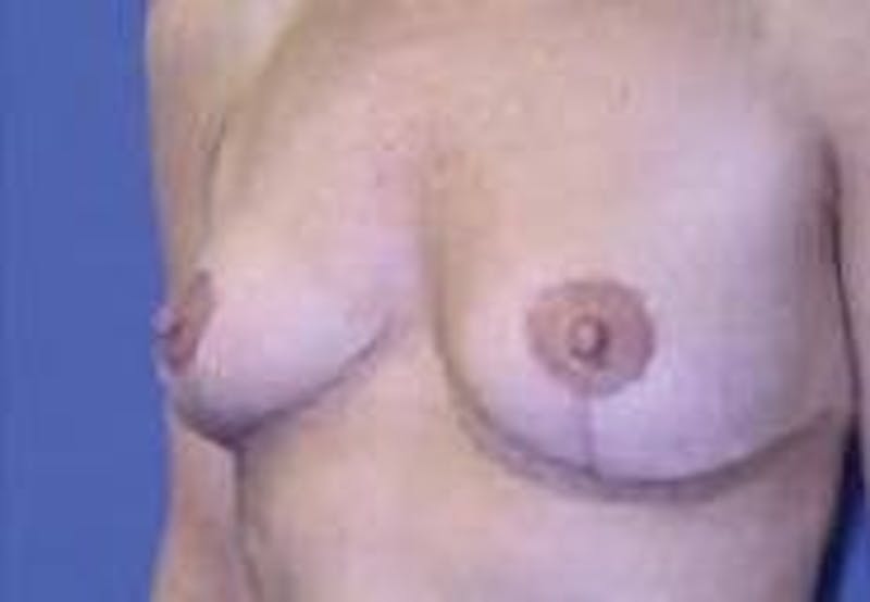 Breast Lift (Mastopexy) Before & After Gallery - Patient 90418414 - Image 6