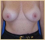 Breast Lift (Mastopexy) Gallery - Patient 90422639 - Image 1