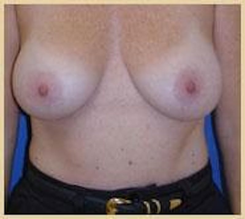 Breast Lift (Mastopexy) Before & After Gallery - Patient 90422639 - Image 1