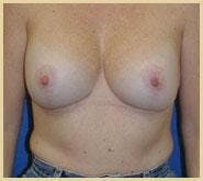 Breast Lift (Mastopexy) Gallery - Patient 90422639 - Image 2