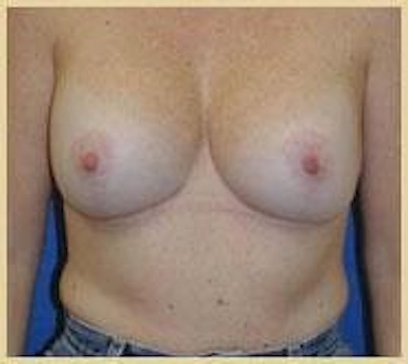 Breast Lift (Mastopexy) Before & After Gallery - Patient 90422639 - Image 2