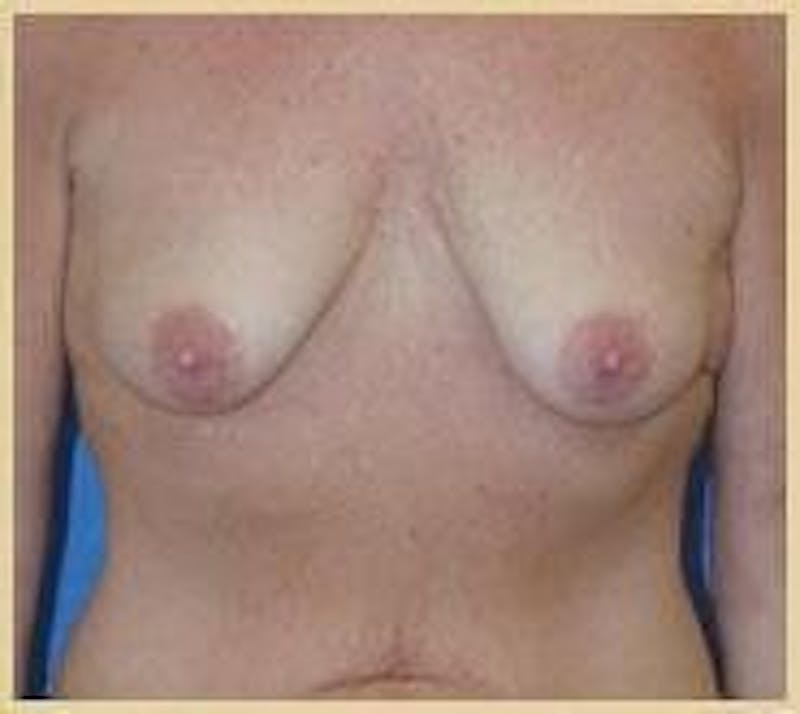 Breast Lift (Mastopexy) Before & After Gallery - Patient 90422641 - Image 1