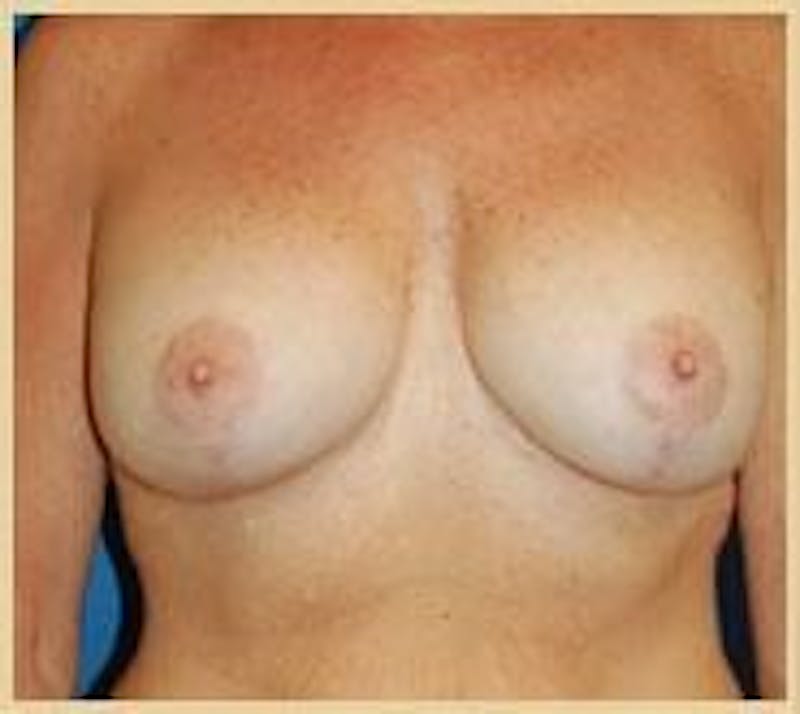 Breast Lift (Mastopexy) Before & After Gallery - Patient 90422641 - Image 2