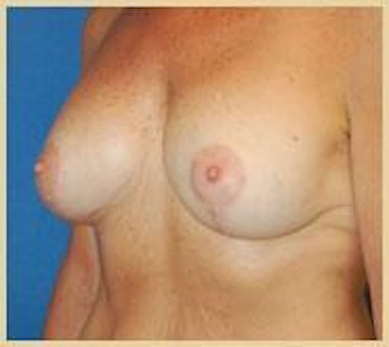 Breast Lift (Mastopexy) Before & After Gallery - Patient 90422641 - Image 4