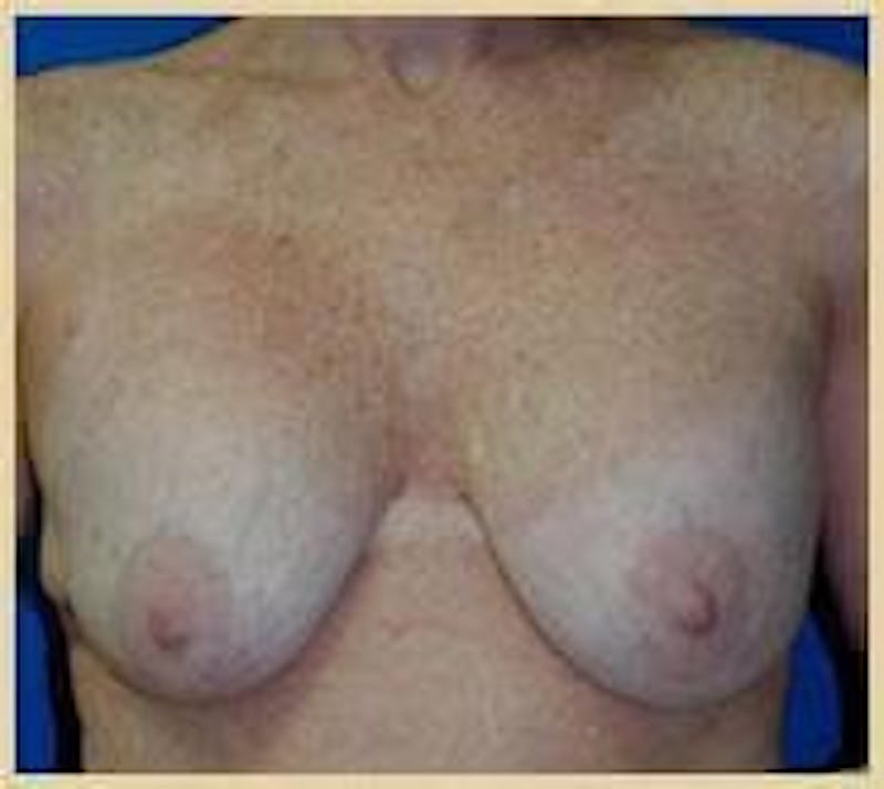 Breast Lift (Mastopexy) Before & After Gallery - Patient 90424900 - Image 1