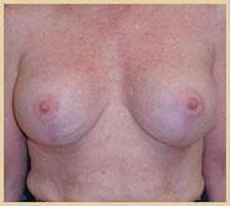 Breast Lift (Mastopexy) Before & After Gallery - Patient 90424900 - Image 2