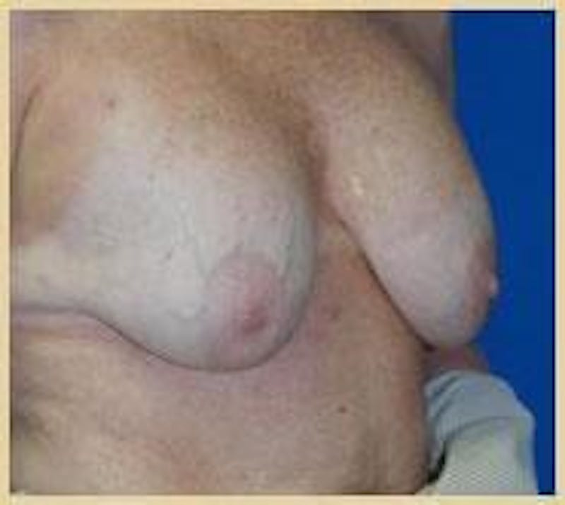 Breast Lift (Mastopexy) Before & After Gallery - Patient 90424900 - Image 3