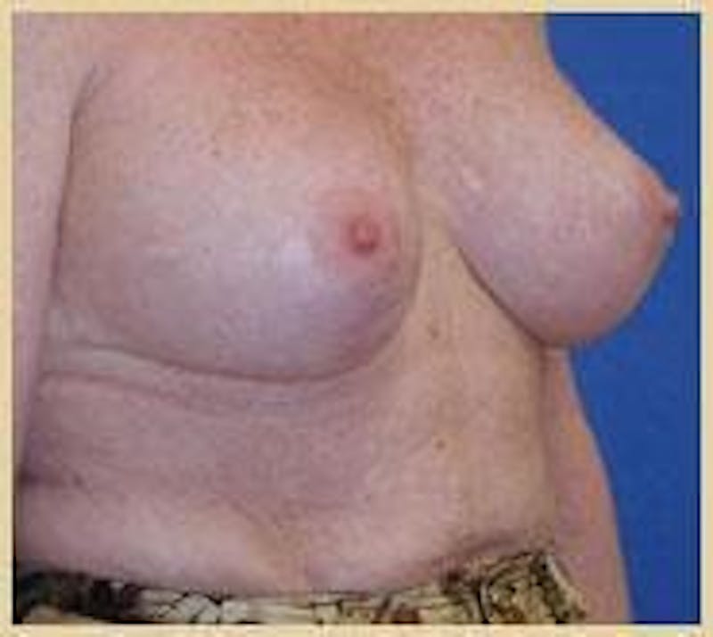 Breast Lift (Mastopexy) Before & After Gallery - Patient 90424900 - Image 4