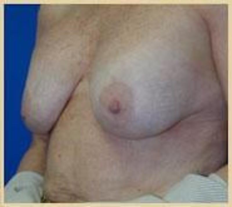 Breast Lift (Mastopexy) Before & After Gallery - Patient 90424900 - Image 5