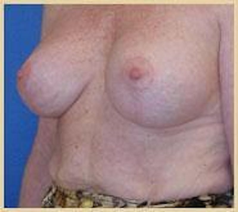 Breast Lift (Mastopexy) Before & After Gallery - Patient 90424900 - Image 6