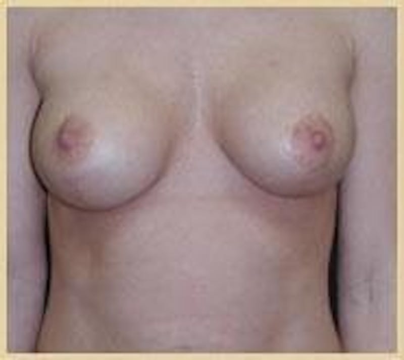 Breast Lift (Mastopexy) Before & After Gallery - Patient 90424903 - Image 2