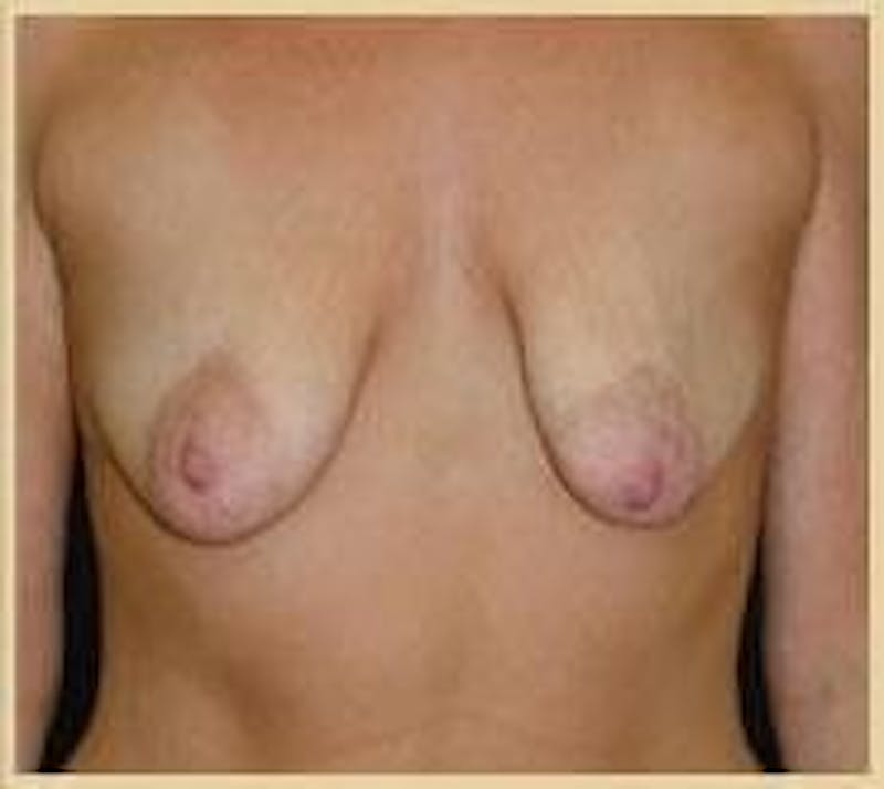 Breast Lift (Mastopexy) Before & After Gallery - Patient 90424903 - Image 3