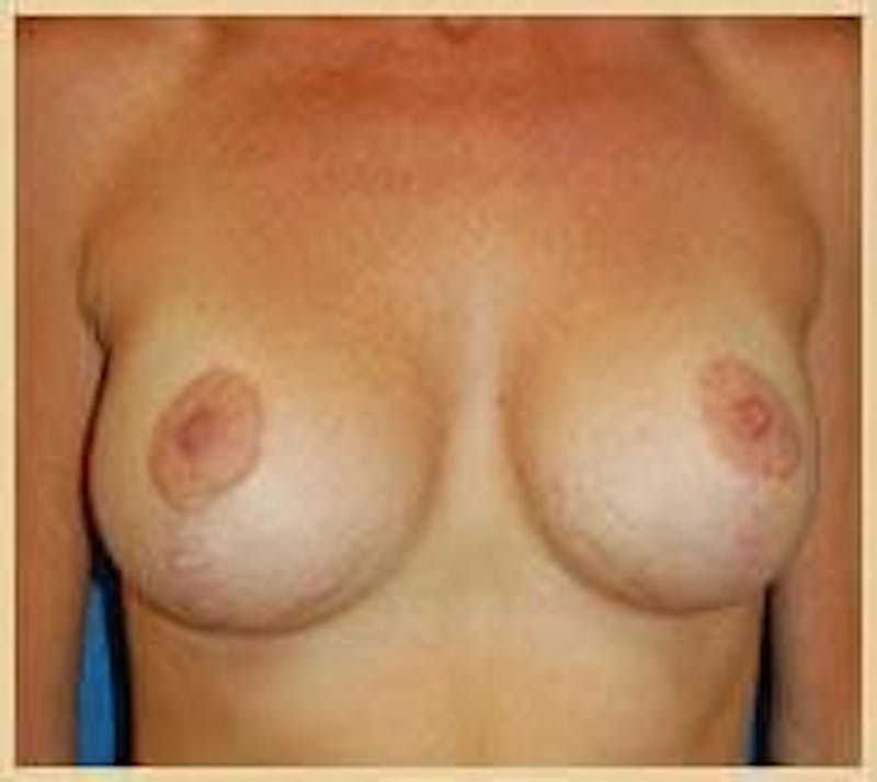 Breast Lift (Mastopexy) Before & After Gallery - Patient 90424903 - Image 4