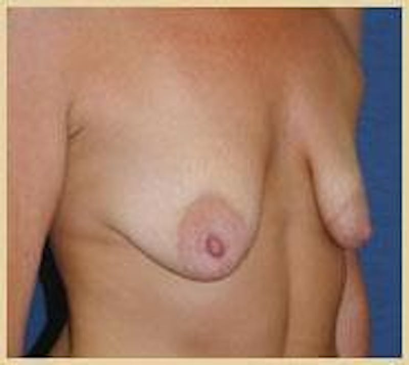 Breast Lift (Mastopexy) Before & After Gallery - Patient 90424903 - Image 5