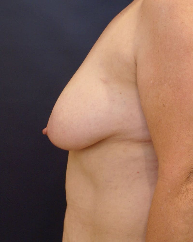 Breast Lift (Mastopexy) Before & After Gallery - Patient 90424913 - Image 5