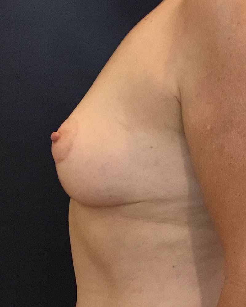 Breast Lift (Mastopexy) Before & After Gallery - Patient 90424913 - Image 6