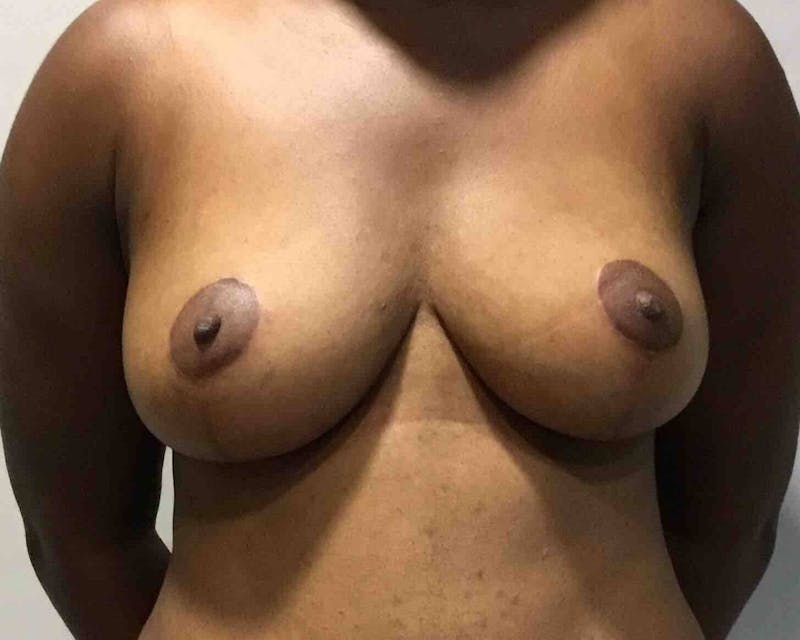 Breast Lift (Mastopexy) Before & After Gallery - Patient 90424919 - Image 2