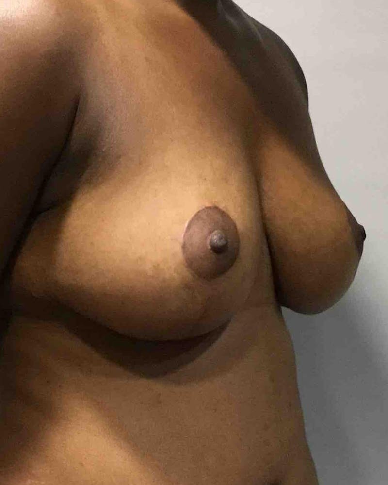 Breast Lift (Mastopexy) Before & After Gallery - Patient 90424919 - Image 4