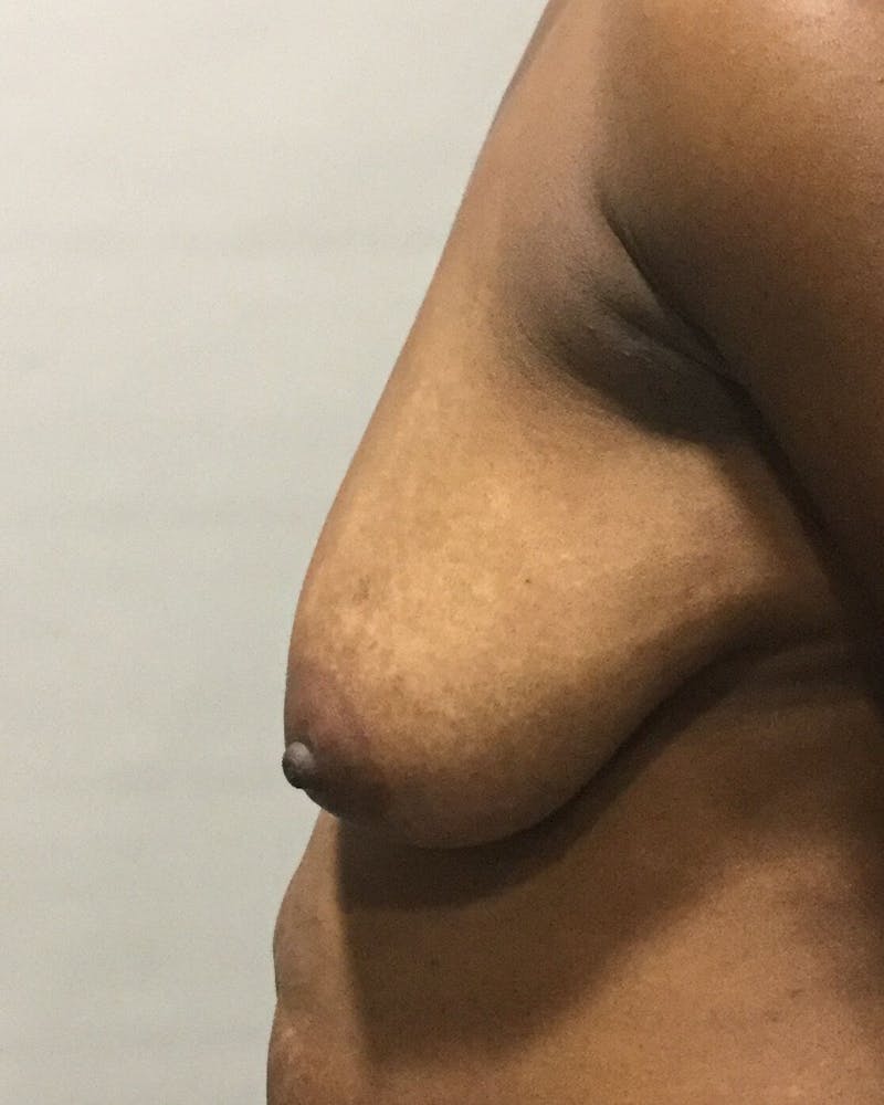 Breast Lift (Mastopexy) Before & After Gallery - Patient 90424919 - Image 5