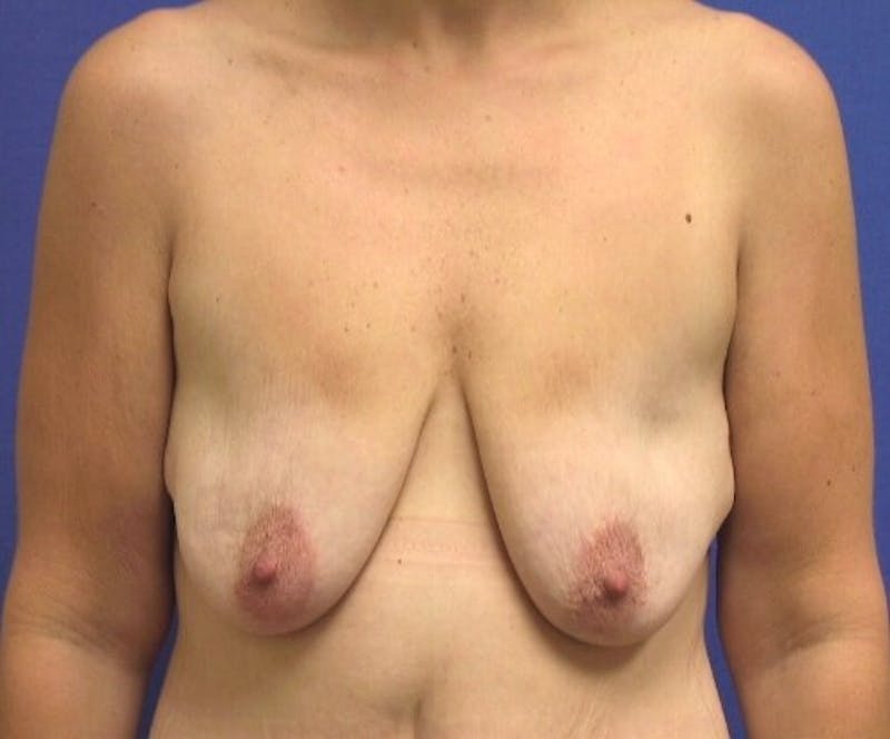Breast Lift (Mastopexy) Before & After Gallery - Patient 90424923 - Image 1