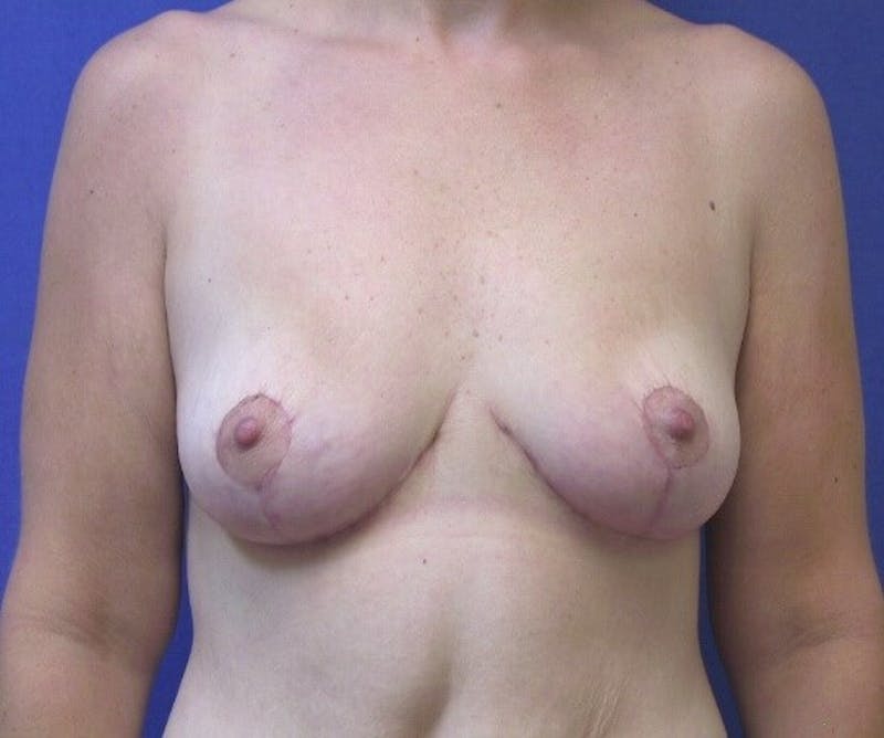 Breast Lift (Mastopexy) Before & After Gallery - Patient 90424923 - Image 2