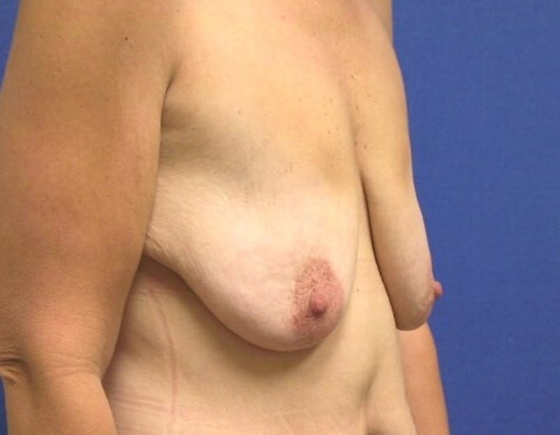 Breast Lift (Mastopexy) Before & After Gallery - Patient 90424923 - Image 3