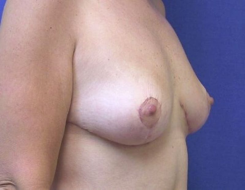 Breast Lift (Mastopexy) Before & After Gallery - Patient 90424923 - Image 4