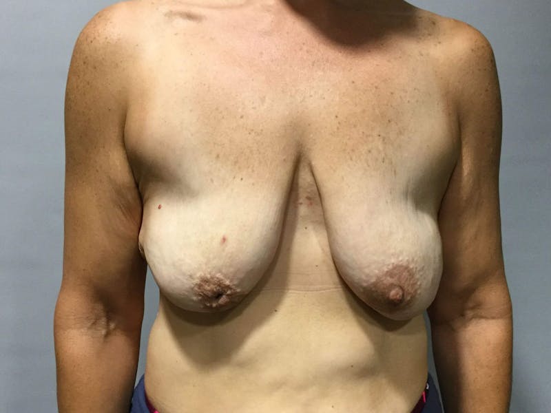 Breast Lift (Mastopexy) Before & After Gallery - Patient 90424924 - Image 1