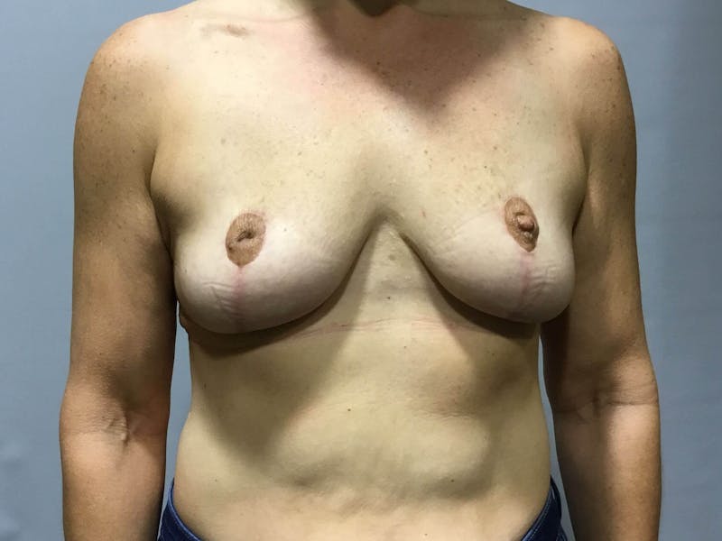 Breast Lift (Mastopexy) Before & After Gallery - Patient 90424924 - Image 2