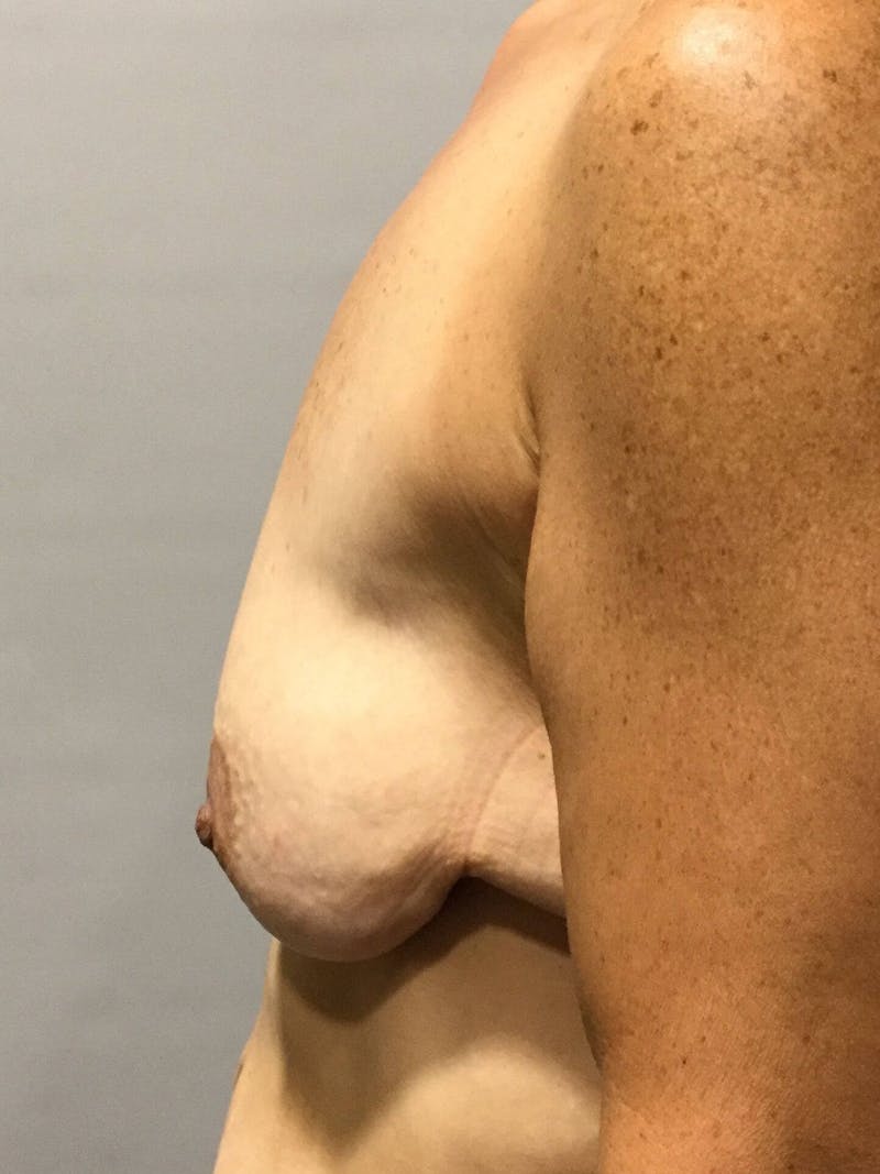 Breast Lift (Mastopexy) Before & After Gallery - Patient 90424924 - Image 3