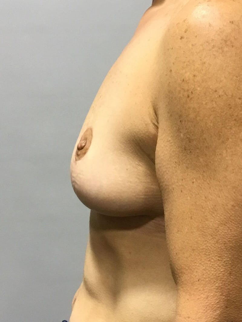 Breast Lift (Mastopexy) Before & After Gallery - Patient 90424924 - Image 4