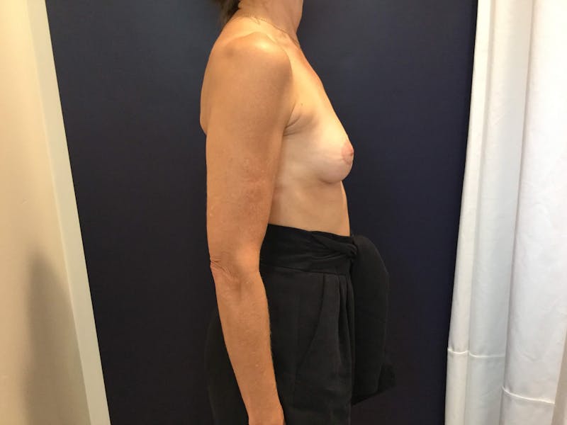 Breast Lift (Mastopexy) Before & After Gallery - Patient 90427196 - Image 8