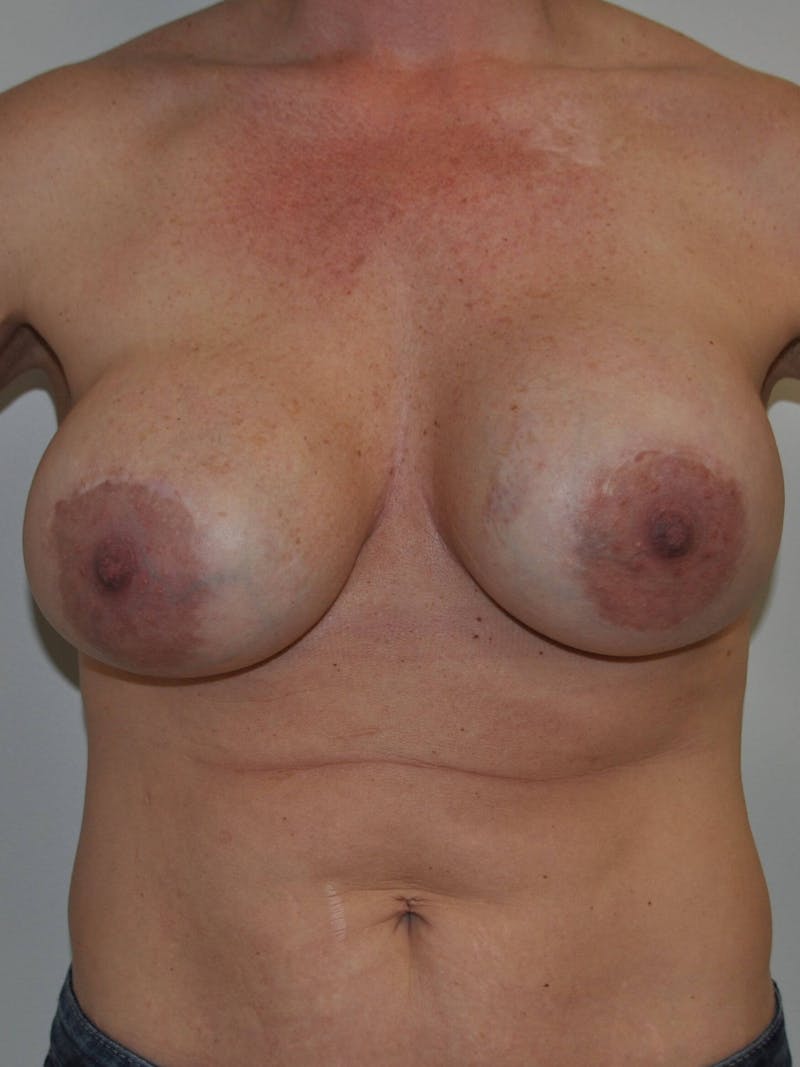 Breast Lift (Mastopexy) Before & After Gallery - Patient 90427203 - Image 1