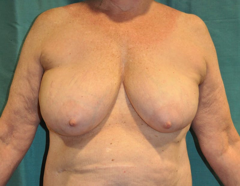 Breast Lift (Mastopexy) Before & After Gallery - Patient 90427223 - Image 1