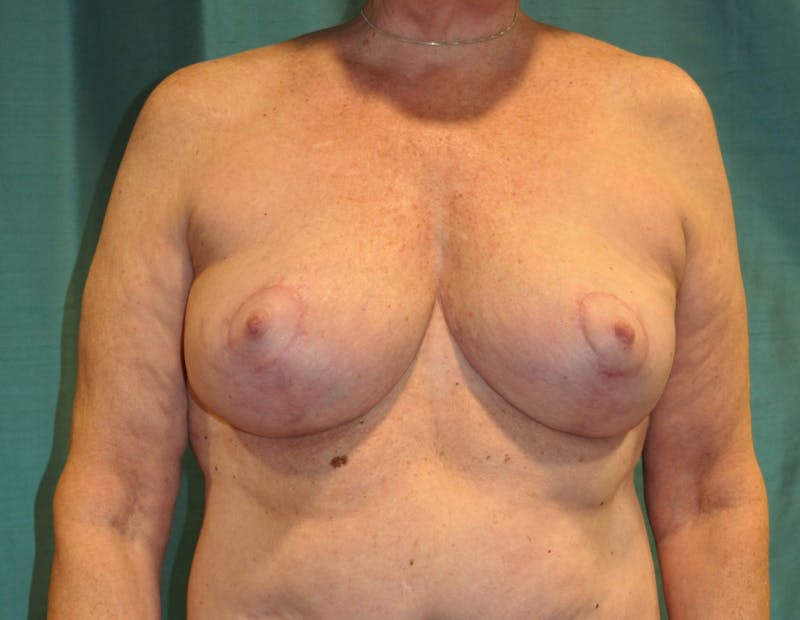 Breast Lift (Mastopexy) Before & After Gallery - Patient 90427223 - Image 2